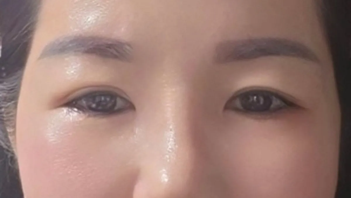 術後