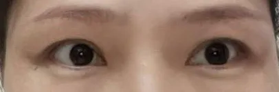 術後