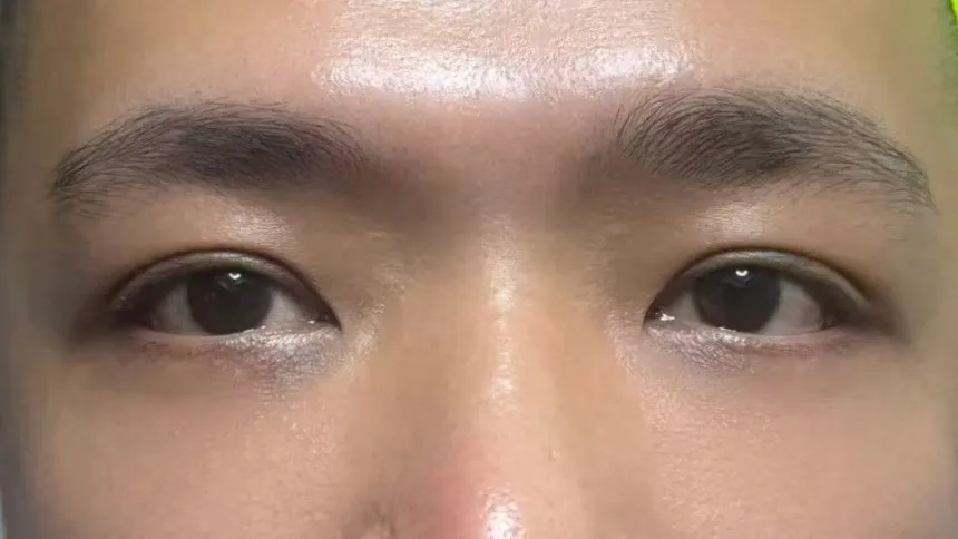 術後