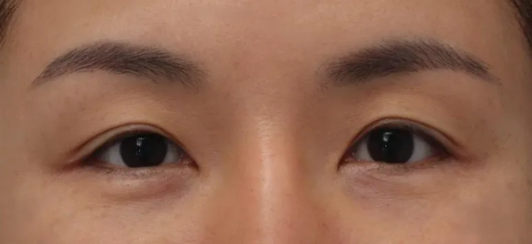 術前